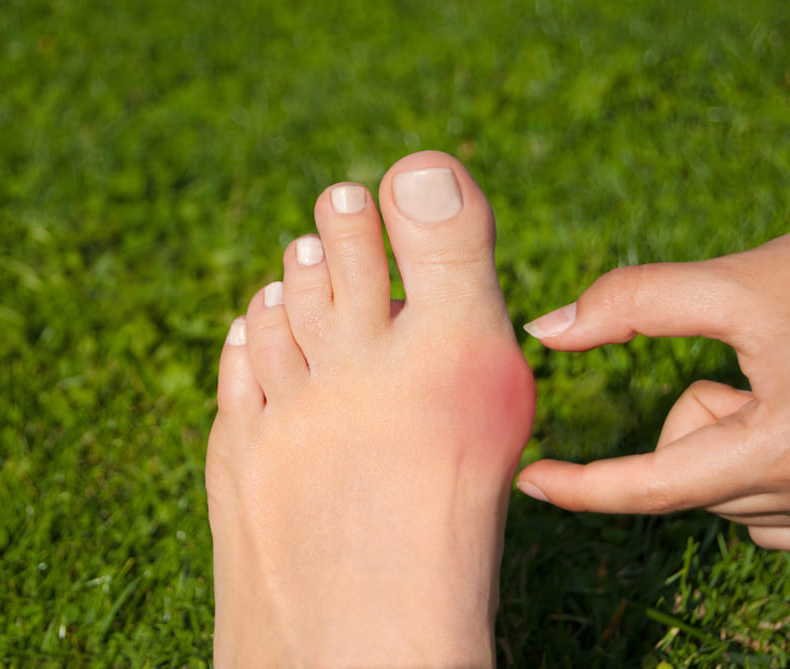 Hallux valgus